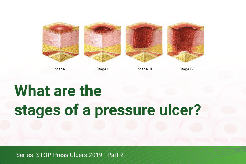 What are the stages of a pressure ulcer